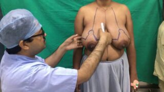 Breast Reduction Demo (Indian Tig Ol Bitties)