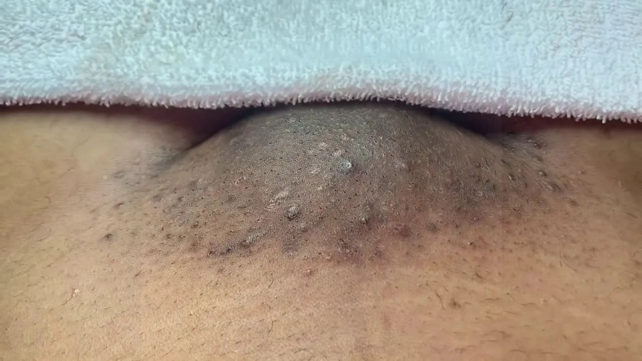 First time I’ve seen a blackhead removal video from the pussy, “Vajacial  (EXTRACTIONS) Hygiene Routine”