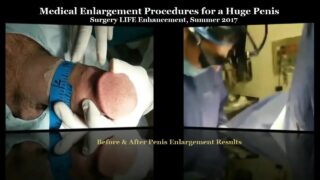 Penis enlargement surgery with Huge one at 2:57