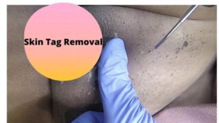 Pubic Area Skin Tag Removal!