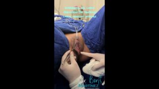 GORE WARNING Rejuvenecimiento vaginal (Labioplastia mas relleno de grasa labios mayores)