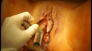 Labiaplasty surgery (labia minora reduction) by Dr. Daniel A. Medalie of Cleveland Plastic Surgery